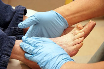 diabetic-foot