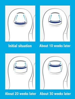 Painless Nail Correction