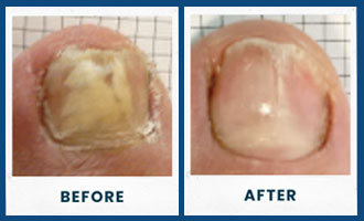 toefx before and after