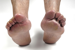 Walking With Rheumatoid Arthritis