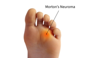Non-Surgical Care Options for Morton’s Neuroma