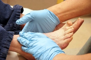 Charcot Foot Can Be a Serious Diabetic Complication