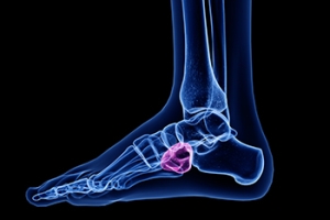 Relieving Foot Pain from Cuboid Syndrome