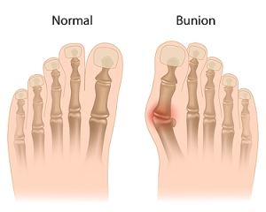 What to Know About Bunion Surgery and Recovery